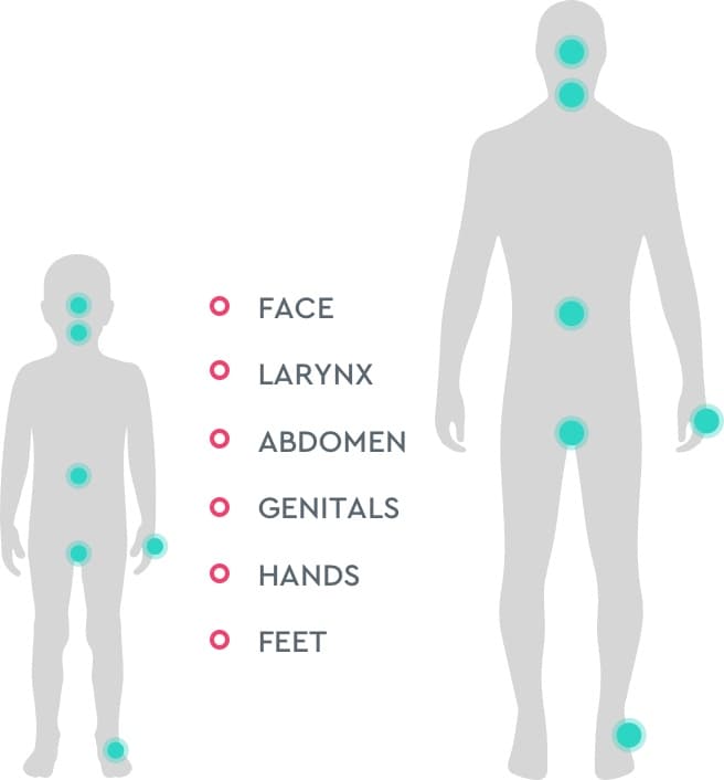 Image of adult and child body figures, indicating areas mostly commonly affected by HAE attacks: face, larynx, abdomen, genitals, hands, and feet.